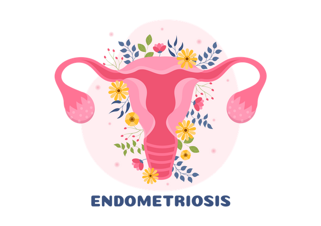 Endometriosis  일러스트레이션