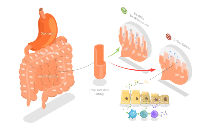 Ilustracion Conceptual De Vector Plano Isometrico 3 D De La Enfermedad Celiaca Diagrama Educativo Ilustración