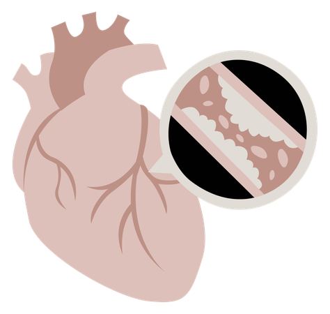 Arteriopatía coronaria  Ilustración