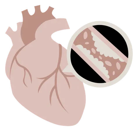 Arteriopatía coronaria  Ilustración