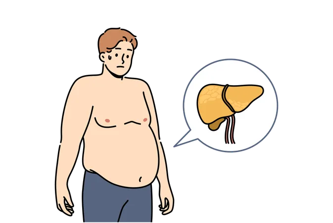 Las enfermedades hepáticas en los hombres provocan obesidad y problemas digestivos y síntomas de hepatosis grasa  Ilustración