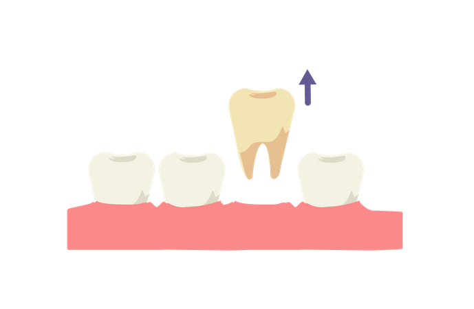 Extração de dente  Ilustração