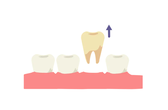 Extraction dentaire  Illustration