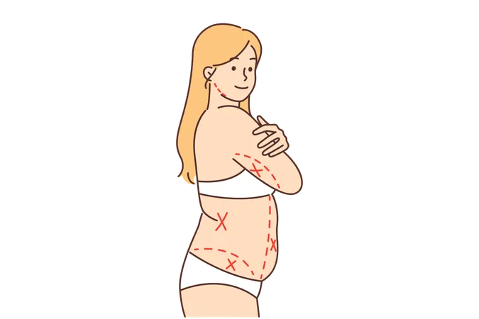 Fat Woman Without Clothes With Lines On Body Is Preparing For Liposuction For Deliverance From Excess Weight Girl In Underwear Wants To Do Liposuction And Get Rid Of Excess Fat On Stomach And Waist Illustration