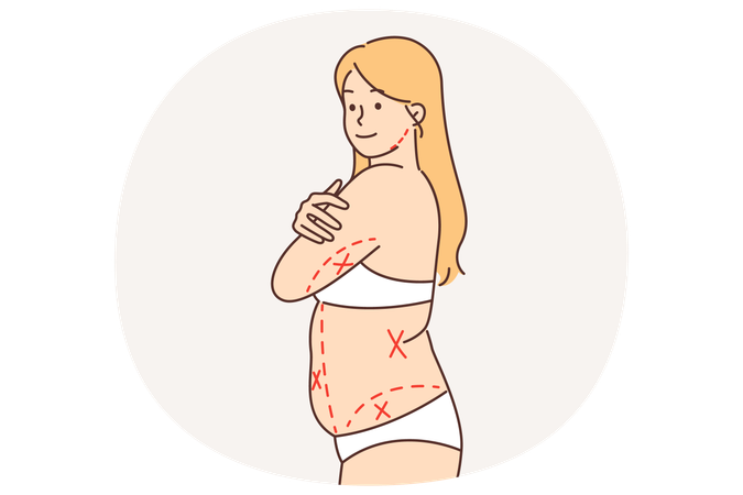 Fat woman without clothes with lines on body preparing for liposuction  Illustration