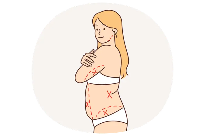 Fat woman without clothes with lines on body preparing for liposuction  Illustration