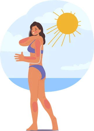 Une femme souffre d'un coup de soleil sur la plage en raison d'une exposition excessive au soleil  Illustration