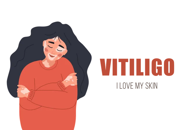 Fille atteinte de vitiligo  Illustration