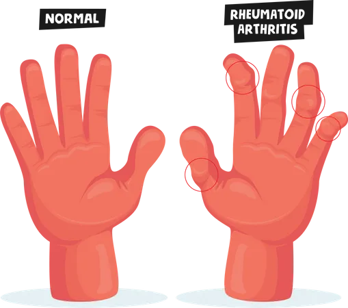 Finger Joints Inflammation Medical Healthcare  Illustration