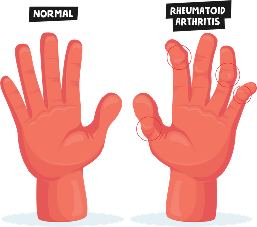 Finger Joints Inflammation Medical Healthcare  Illustration