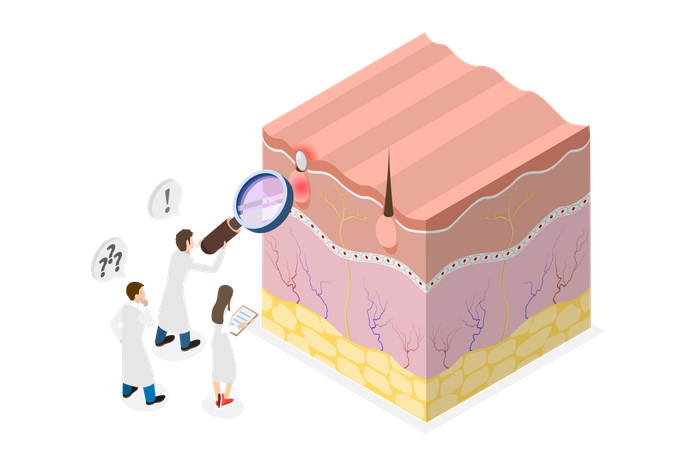 Formation of skin pimple  イラスト