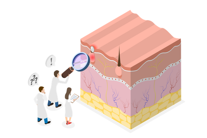 Formation of skin pimple  Illustration