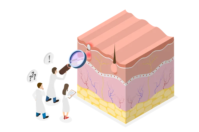 Formation of skin pimple  Illustration