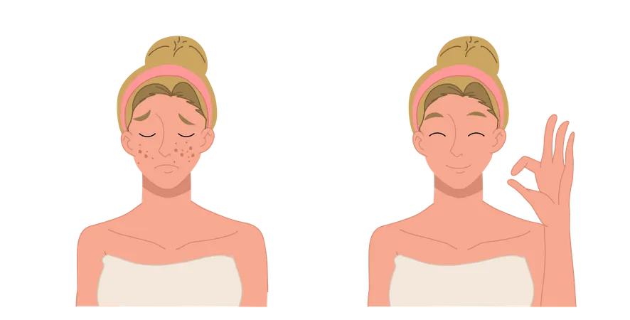 Hautpflegekonzept Frau Madchen Mit Akne Vor Und Nach Akne Flache 2 D Cartoon Charakterillustration Illustration