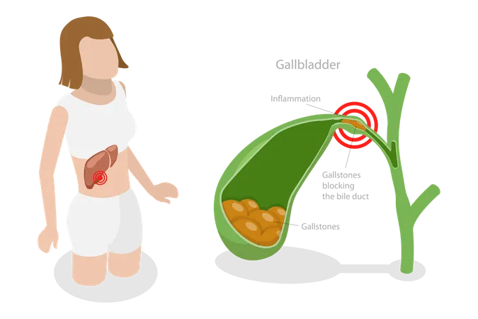 Gallstone Disease  Illustration