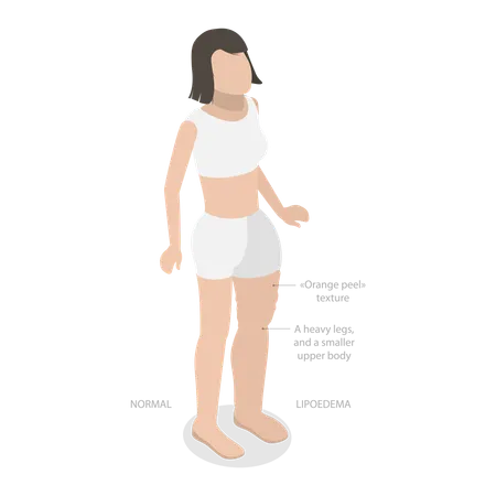 3 D Isometric Flat Vector Illustration Of Lipoedema Overweight Issues Illustration