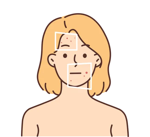 Girl having signs of acne on face  Illustration