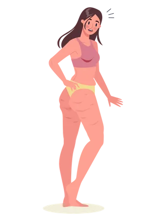 Young Woman With Cellulite On Her Thighs Girl In Underwear With Skin Problem On Her Leg Overweight Body Isolated Vector Illustration In Cartoon Style Illustration