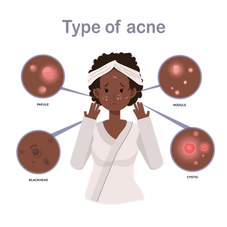 Girl with Acne On Face Illustration