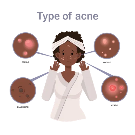Girl with Acne On Face  Illustration