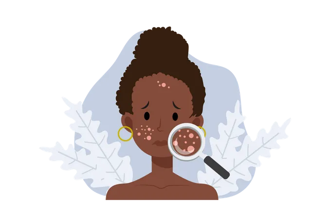 Acne Skin Problems Concept African American Woman With Magnifying Glass Is Looking Acne On His Facial Falt Vector Cartoon Illustration Illustration
