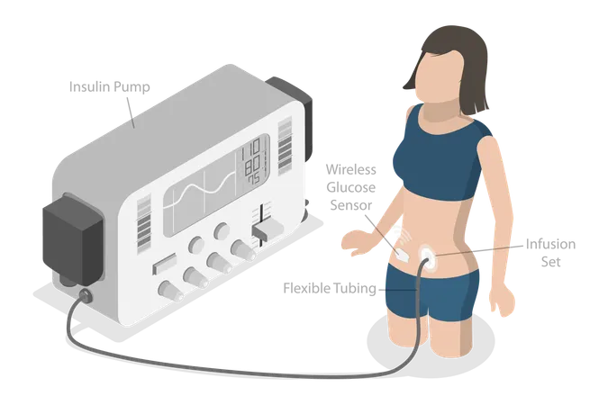 Girl with Insulin Infusion Pump  Illustration