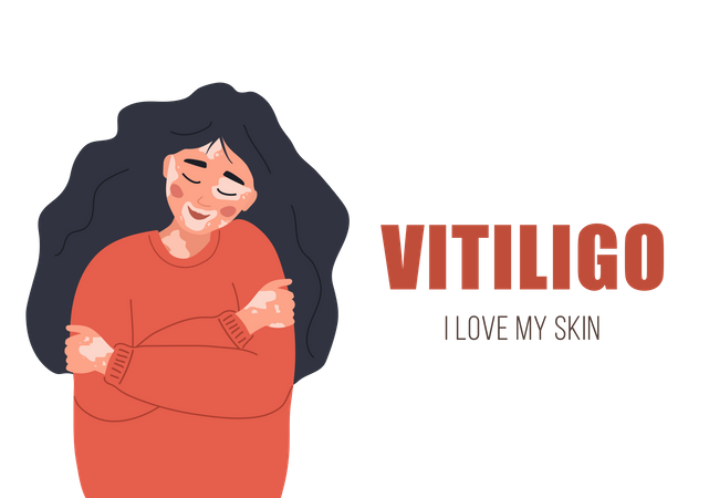 Girl with vitiligo  Illustration