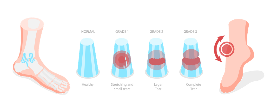 Graus de entorse, problema no tornozelo  Illustration