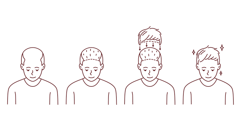 Hair transplant  Illustration