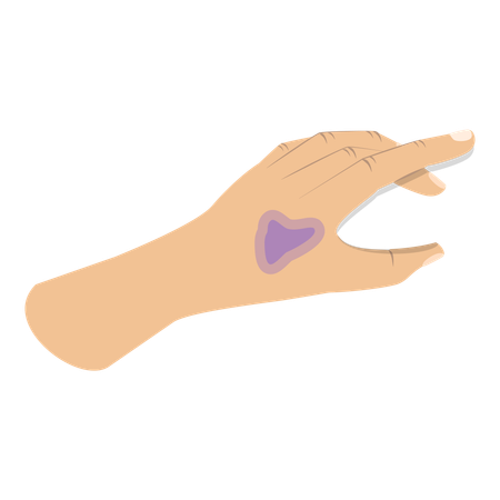 Hand with physical injury  Illustration