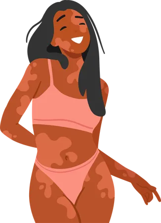Confident Happy Woman With Vitiligo Embraces Her Unique Beauty Radiating Joy In A Stylish Bikini Female Character Challenging Conventional Standards And Celebrating Diversity With Pride Illustration
