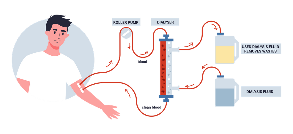 Hemodiálise para tratamento renal  Ilustração