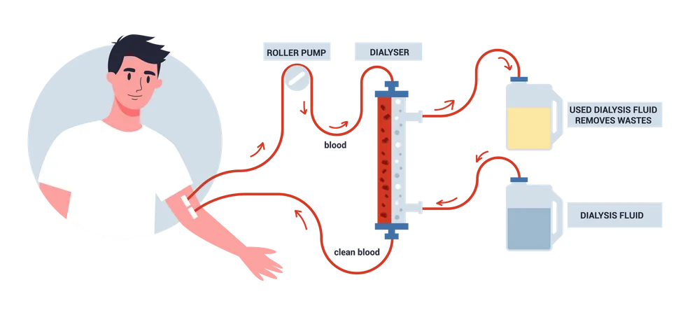 Hemodiálise para tratamento renal  Ilustração