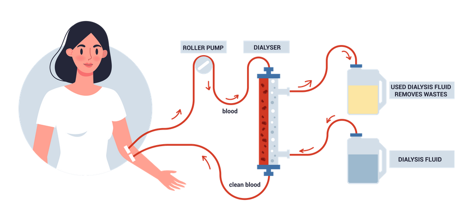 Hemodiálise para tratamento renal  Ilustração