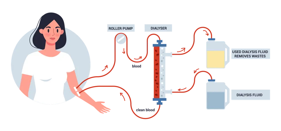 Hemodiálise para tratamento renal  Ilustração