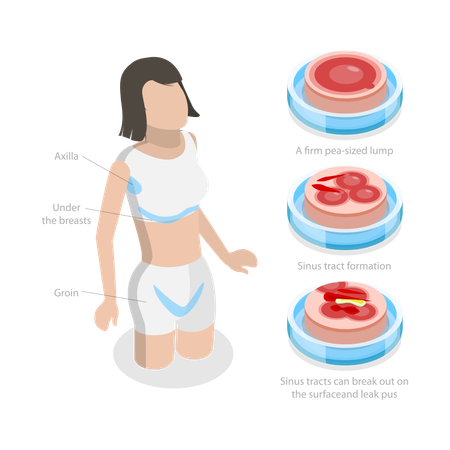 Hidradenitis Suppurativa  Illustration