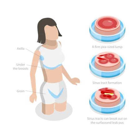 Hidradenitis Suppurativa  Illustration