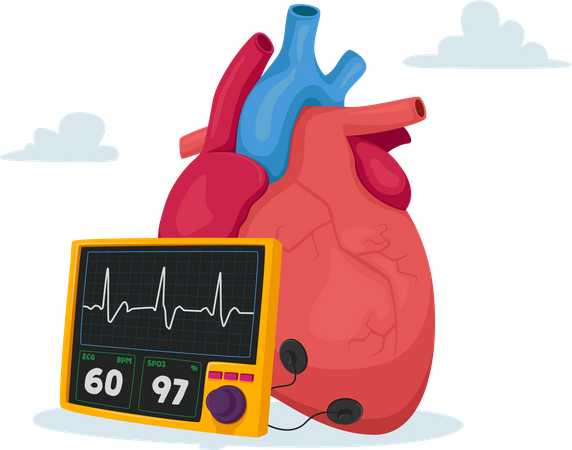 High Cholesterol Blood Pressure and Atherosclerosis  Illustration