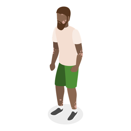 Homem com vitiligo  Ilustração