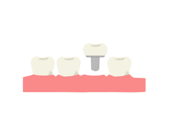 Implant dentaire  Illustration