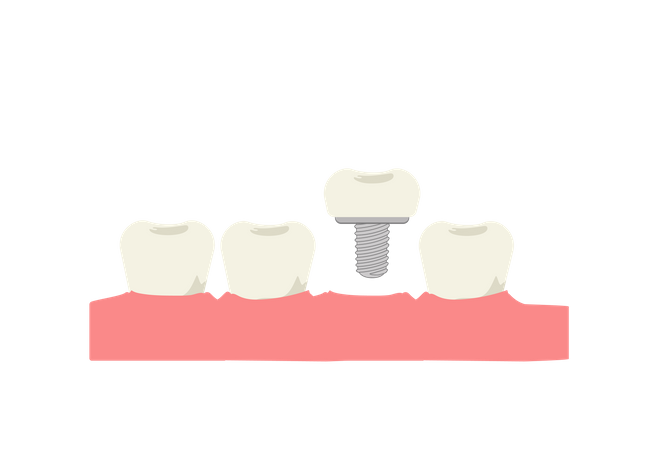 Implante dentário  Ilustração