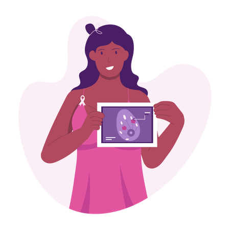 Informe sobre el cáncer de mama  Ilustración