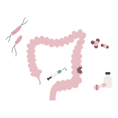 Intestine cancer disease  Illustration