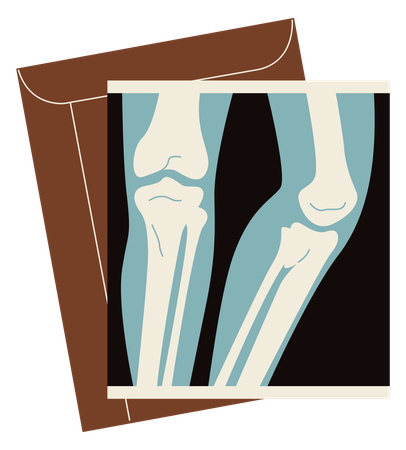 Radiographie d'une jambe cassée  Illustration