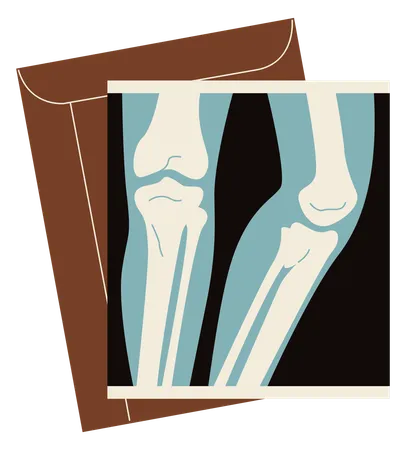 Radiographie d'une jambe cassée  Illustration
