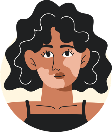 Jeune femme noire atteinte de vitiligo  Illustration