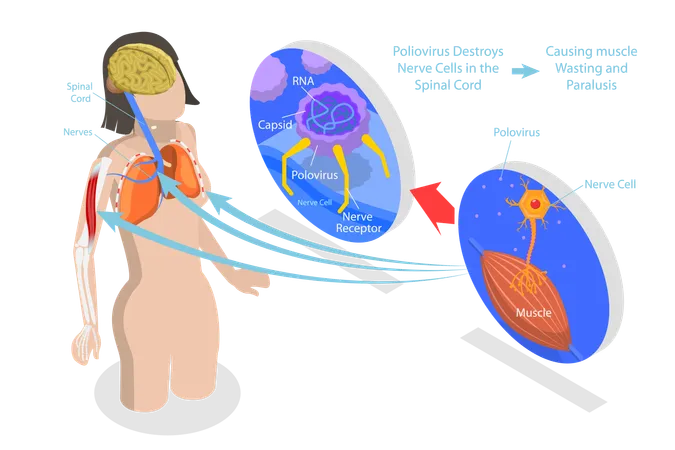 3 D Isometric Flat Vector Conceptual Illustration Of Poliomyelitis Labeled Medical Virus Infection Symptoms Explanation Scheme Illustration