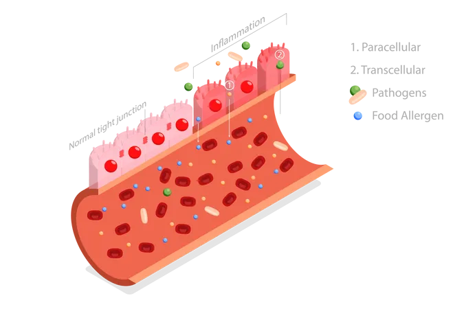 3 D Isometric Flat Vector Conceptual Illustration Of Leaky Gut Syndrome Autoimmune Disorder Illustration