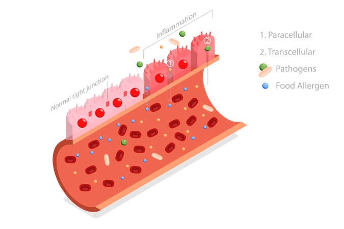 Leaky gut syndrome  Illustration