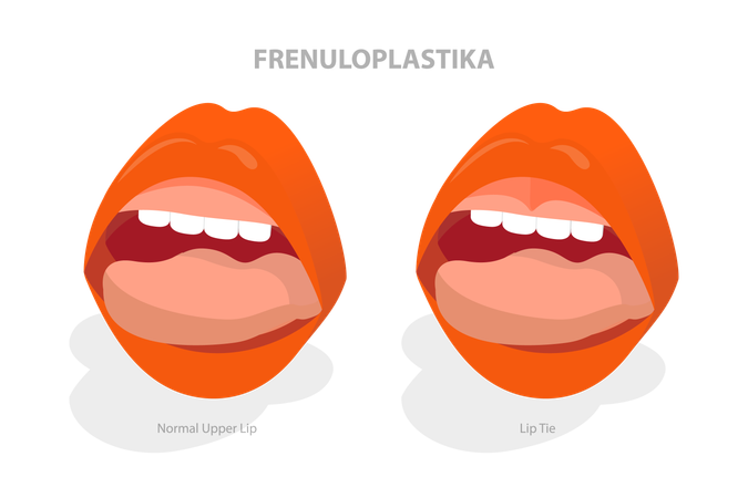 Lip Tie Before and After Surgery  Illustration
